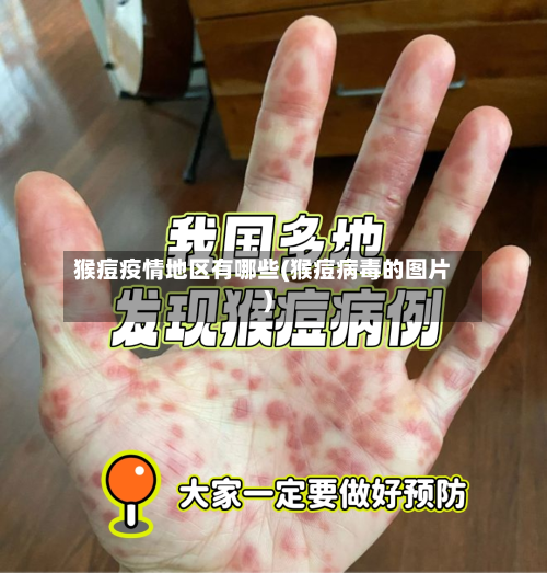猴痘疫情地区有哪些(猴痘病毒的图片)-第1张图片